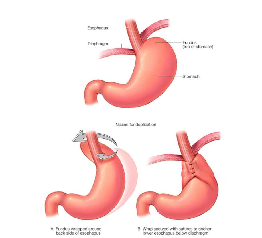 Laparoscopic Hiatal Hernia Repair