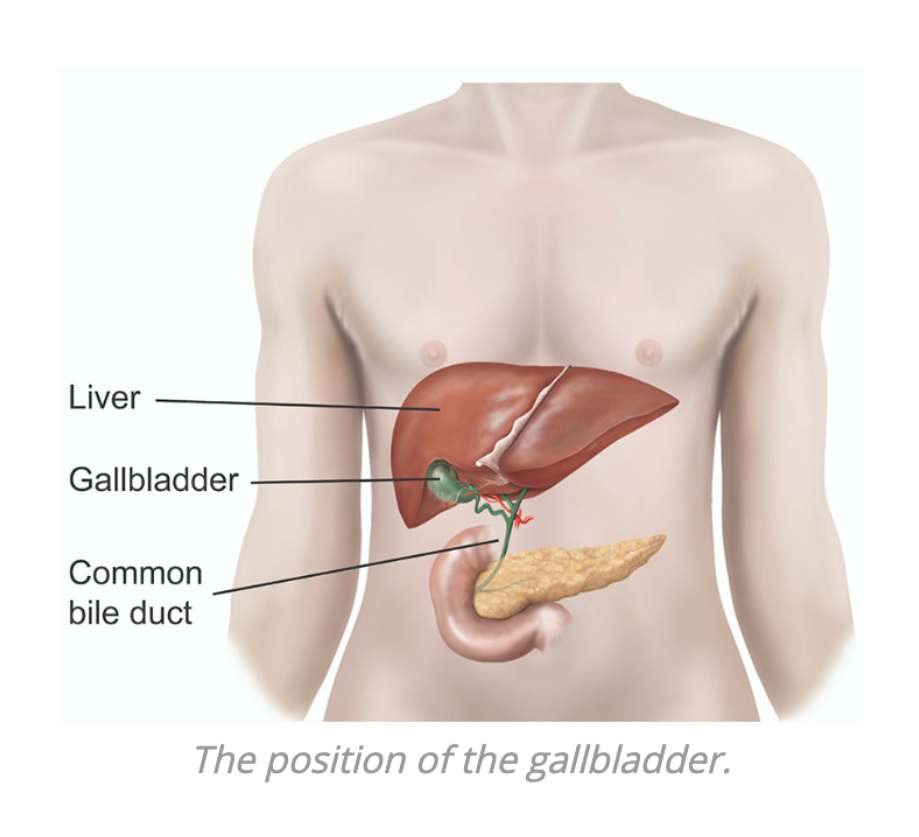 Laparoscopic Cholecystectomy