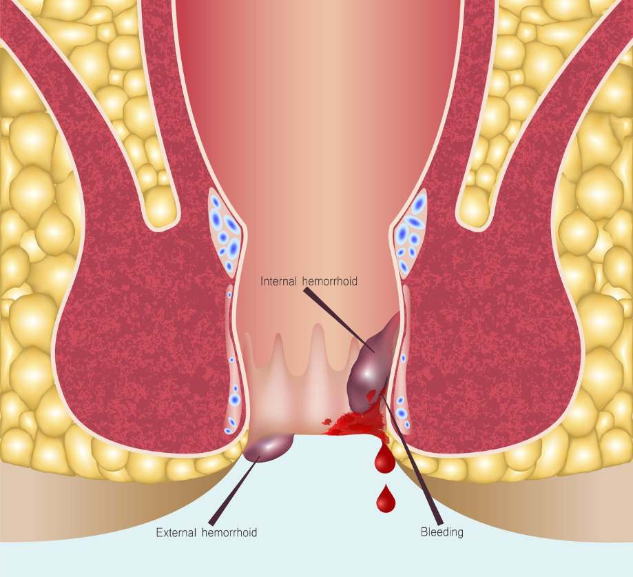 Hemorrhoids