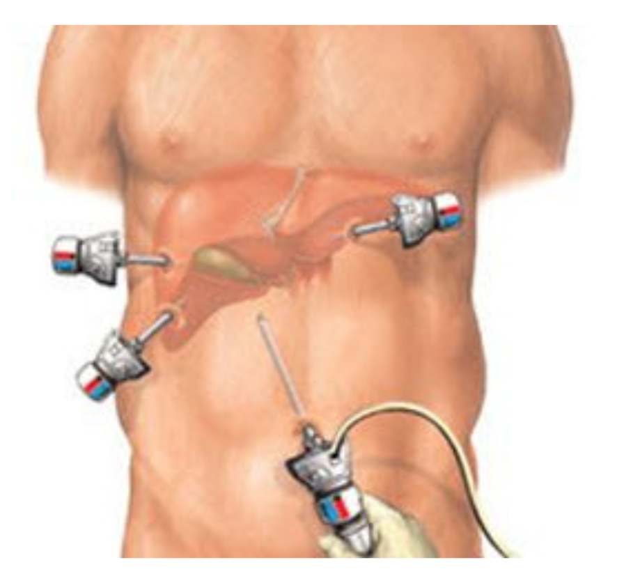 Laparoscopic Surgery Cost in Dubai Know all about it