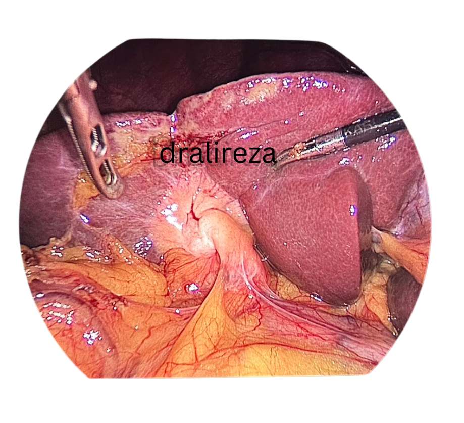 Difficult Cholecystectomy for Acute Cholecystitis