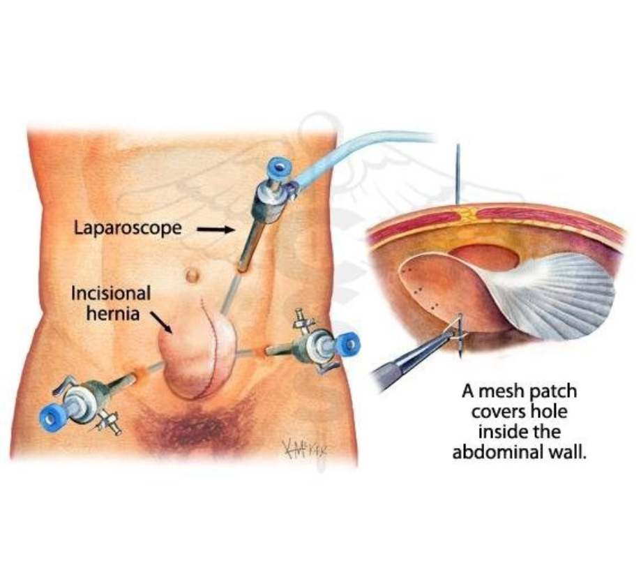 Laparoscopic Hernia Repair