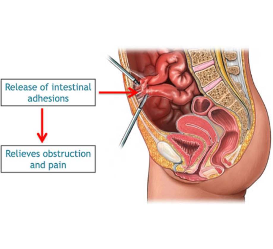 Laparoscopic Adhesiolysis