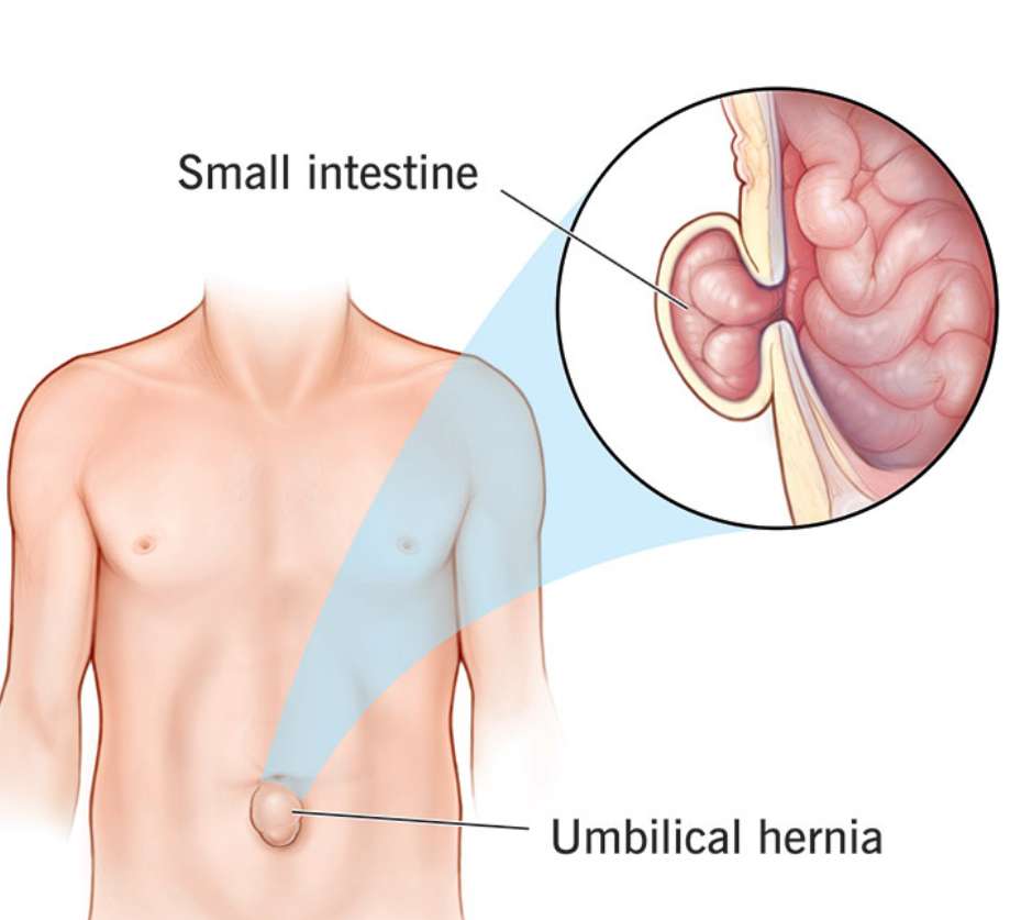 A Comprehensive Guide on Umbilical Hernia