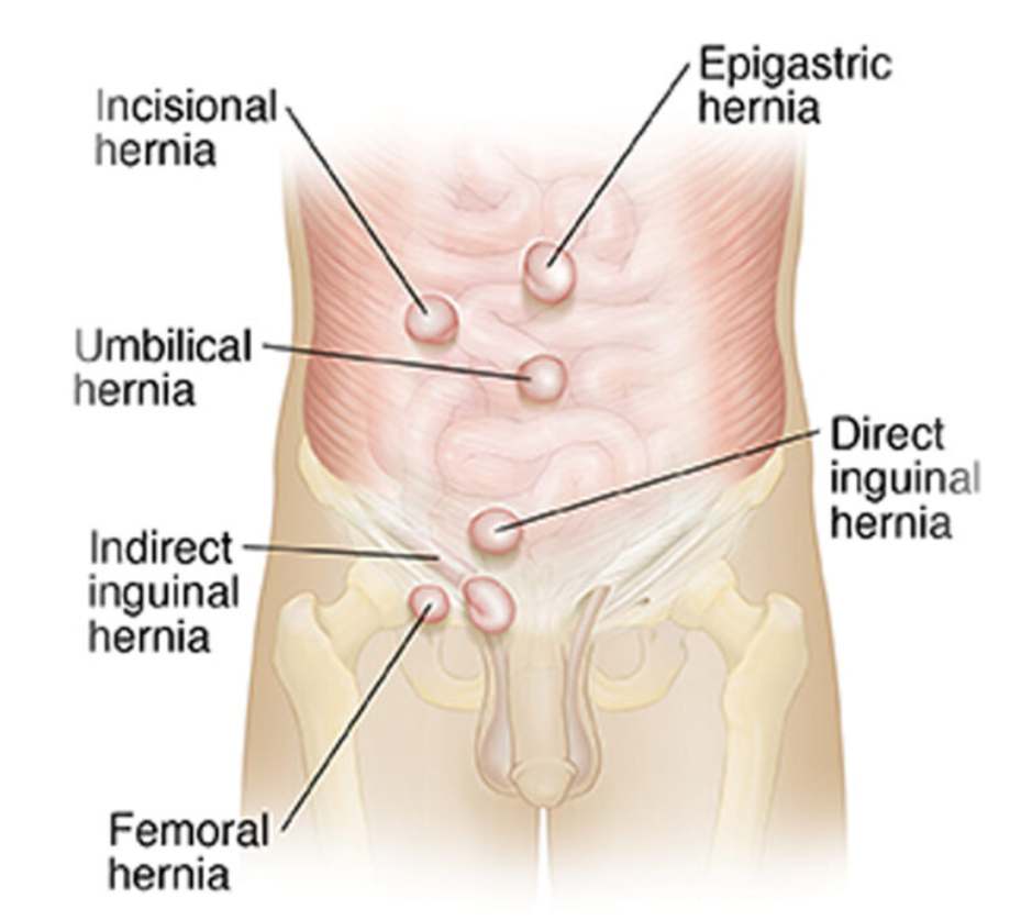 Hernia Surgery in Dubai