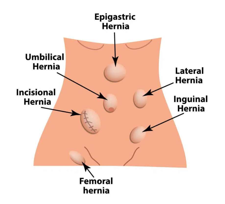 Common Abdominal Hernias and Treatments