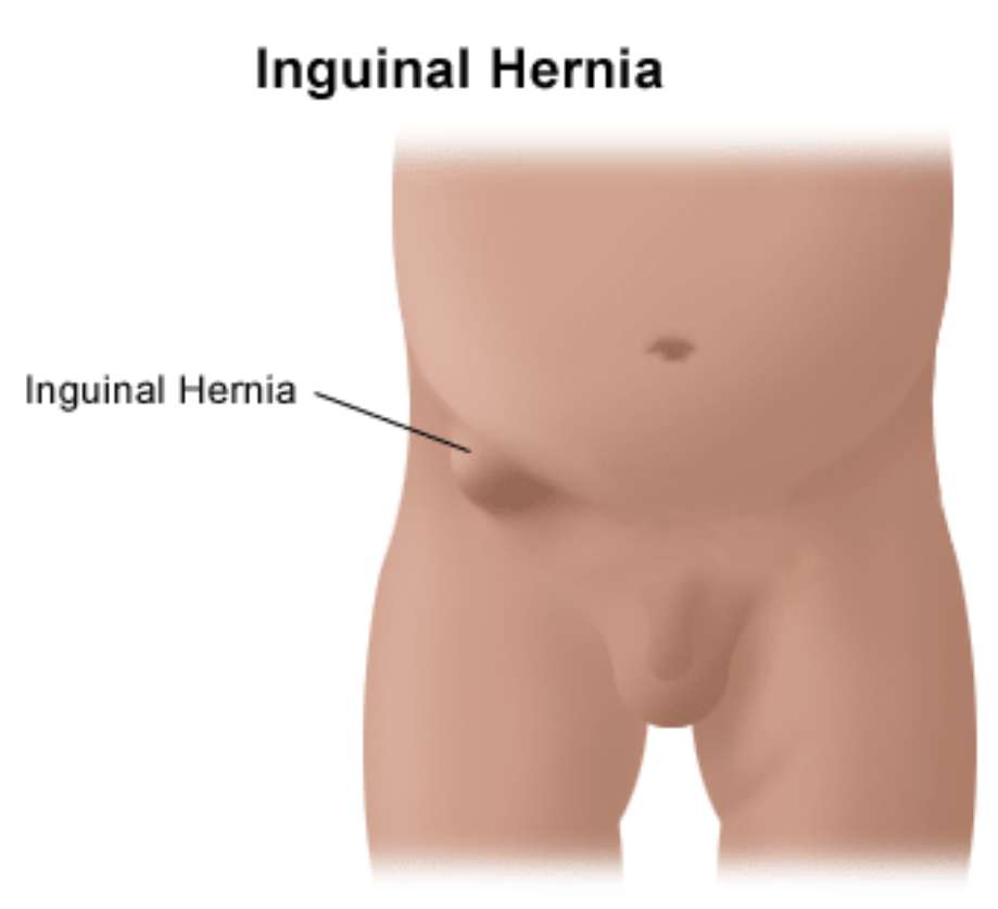 All You Need to Know About Inguinal Hernia