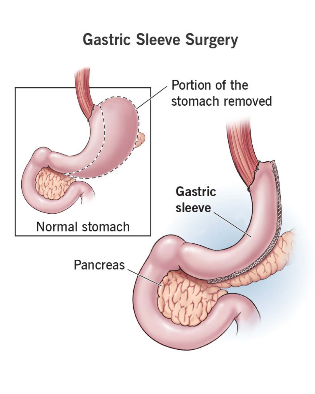 Sleeve Gastrectomy and Reflux